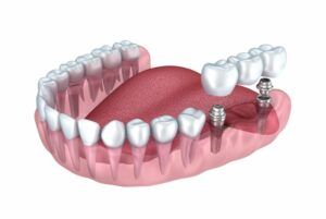 protezirovanie zubov — implantanty zubov 1024x685 1024x685 1